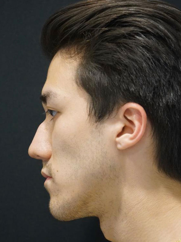 Liquid Rhinoplasty Before and After | Kotis